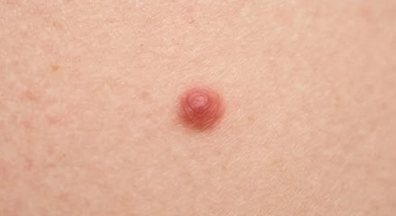 Nốt ruồi sau lưng: Ý nghĩa tướng số nam nữ và đánh giá an toàn 5 Sự khác biệt rõ rệt về màu sắc giữa nốt ruồi đen và nốt ruồi son đỏ trên da