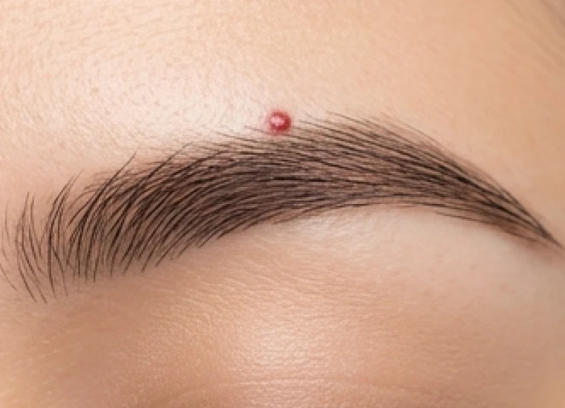 Nốt ruồi ở lông mày: Giải mã tướng số và góc nhìn y khoa 6 Nét đẹp nổi bật của nốt ruồi son màu hồng nhạt mọc lồi nhẹ ngay khu vực giữa đỉnh lông mày