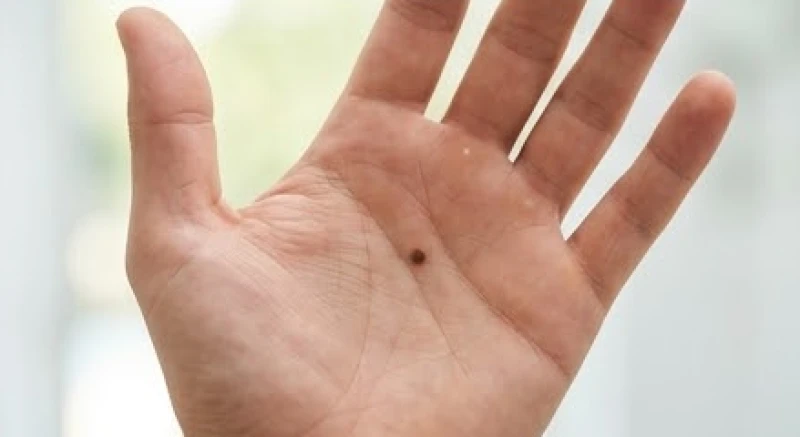 Nốt ruồi phú quý hiếm gặp: Bản đồ tọa độ và tiêu chí nhận diện 7 Nốt ruồi đen bóng nằm ở gò Mộc Tinh trong lòng bàn tay nam giới mang đến quyền lực và tài lộc to lớn