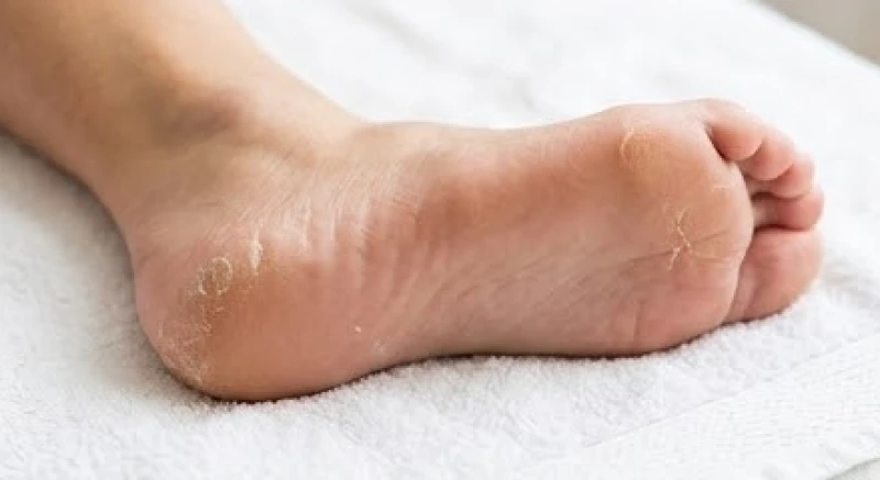 Cận cảnh lòng bàn chân bị khô nẻ bong tróc lớp sừng trắng dưới ánh sáng tự nhiên