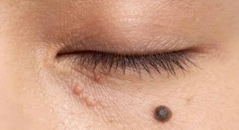 Nốt ruồi trên mí mắt: Ý nghĩa tướng số và bảng giá tẩy an toàn 5 Những nốt mụn thịt mọc li ti quanh vùng da dưới mắt cần phân biệt rõ với nốt ruồi