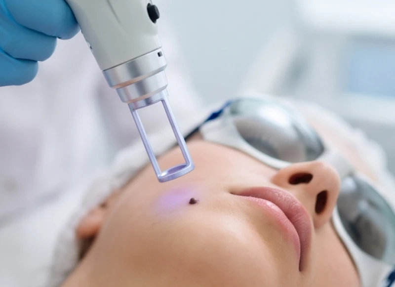 Quá trình chiếu tia laser công nghệ cao để xóa bỏ nốt ruồi tận gốc một cách an toàn