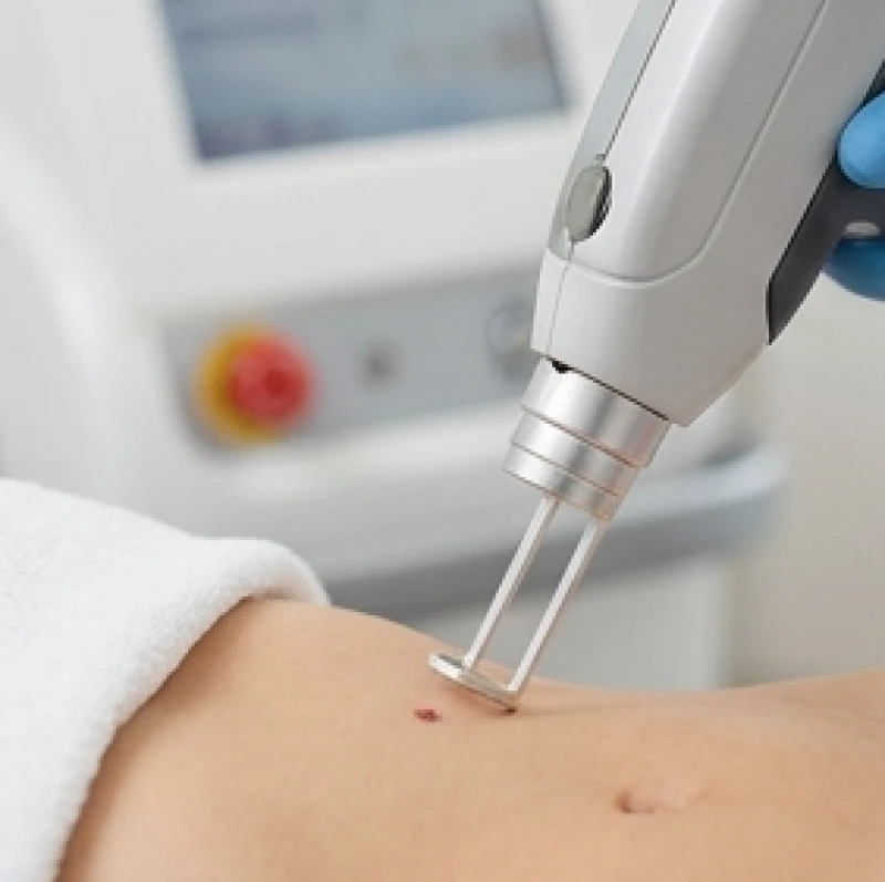 Bác sĩ tiến hành tẩy nốt ruồi bằng công nghệ laser CO2 Fractional