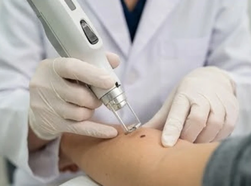 Bác sĩ da liễu đang sử dụng máy Laser CO2 hiện đại để tẩy nốt ruồi ở tay cho bệnh nhân một cách an toàn