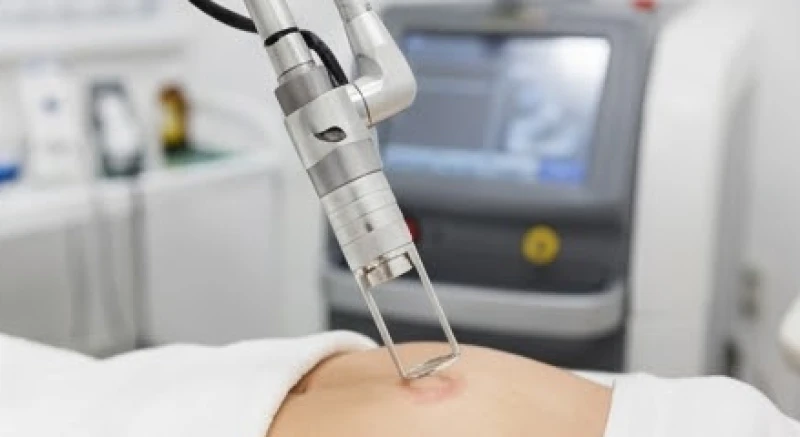 Thiết bị laser CO2 hiện đại đang được sử dụng để điều trị các vấn đề sắc tố da