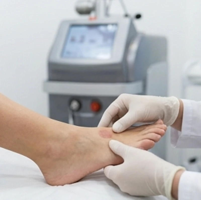 Nốt ruồi ở lòng bàn chân nữ: Giải mã vị trí và dấu hiệu sức khỏe 7 Bác sĩ da liễu sử dụng công nghệ laser hiện đại để bóc tách nốt ruồi một cách an toàn