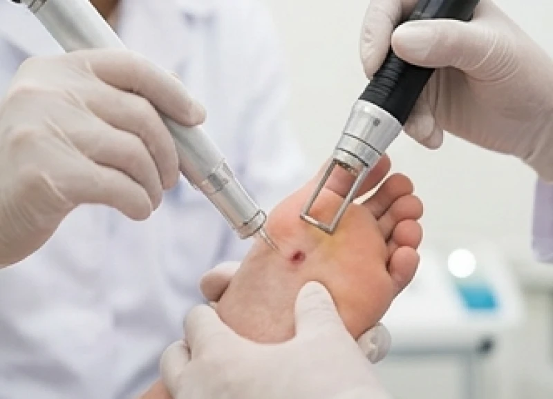 Bác sĩ da liễu đang sử dụng công nghệ Laser CO2 Fractional để điều trị nốt ruồi