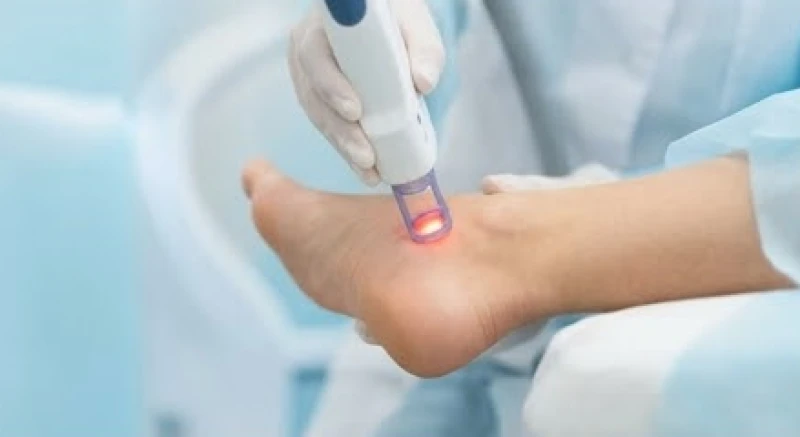 Bắn laser CO2 để tẩy nốt ruồi ở gót chân một cách an toàn và không để lại sẹo lõm tại phòng khám da liễu chuyên khoa