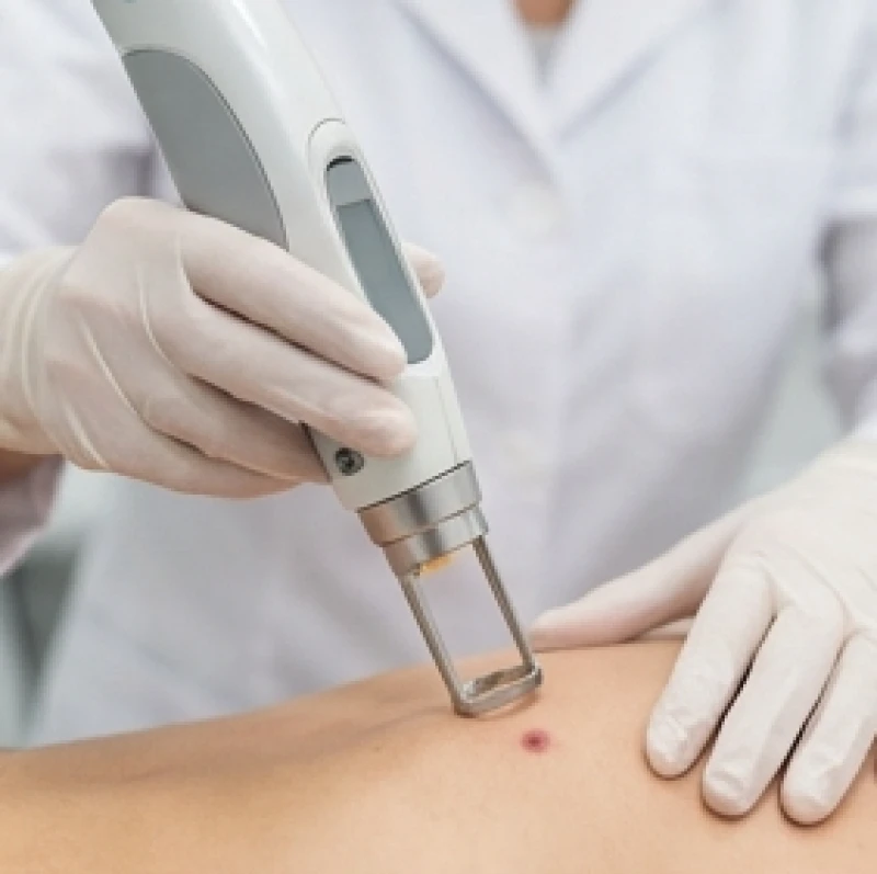 Quá trình tẩy nốt ruồi bằng công nghệ tia laser vi điểm hiện đại giúp loại bỏ sắc tố melanin an toàn