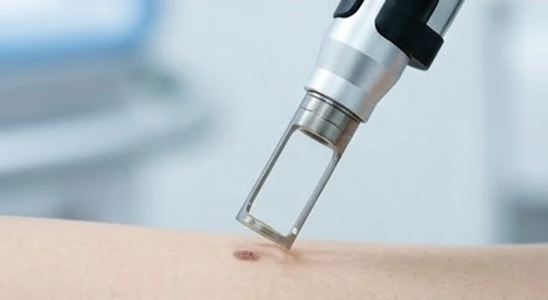 Nốt ruồi ở tai nam: Luận tướng số và bảng giá tẩy xăm an toàn 6 Thiết bị laser CO2 siêu vi phân đang chiếu tia sáng để bóc tách nốt ruồi trên da
