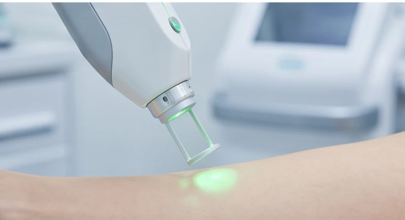 Quy trình ứng dụng công nghệ laser CO2 hiện đại để bóc tách nốt ruồi nhẹ nhàng