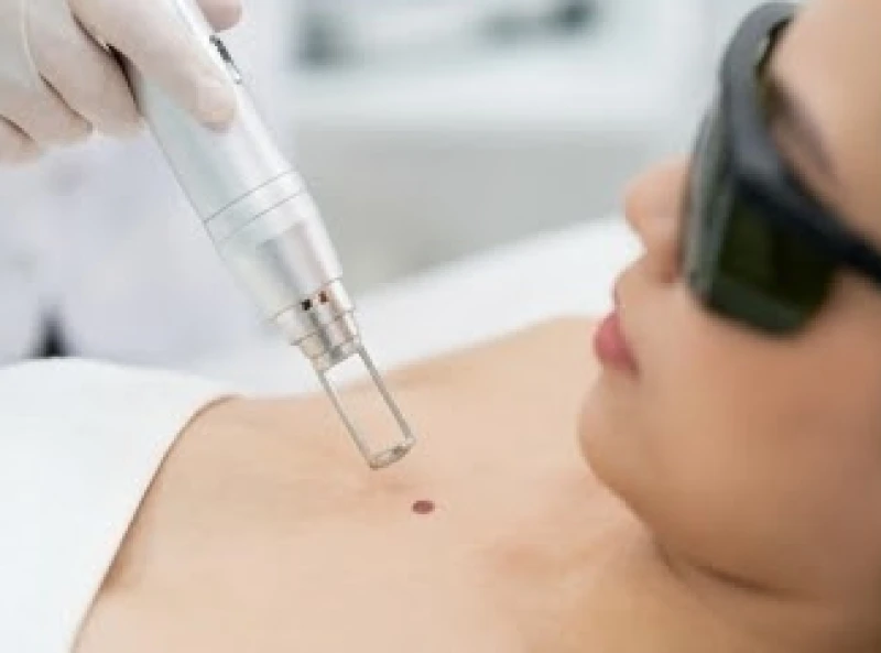 Chuyên viên thẩm mỹ thao tác máy tia laser để loại bỏ nốt ruồi trên da
