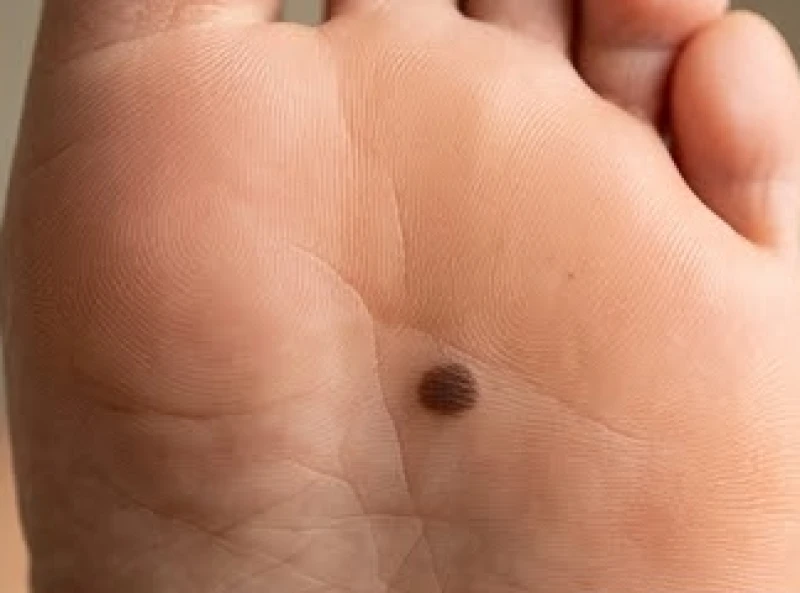 Cấu trúc mô da dưới lòng bàn chân nơi tế bào hắc tố tập trung tạo thành nốt ruồi