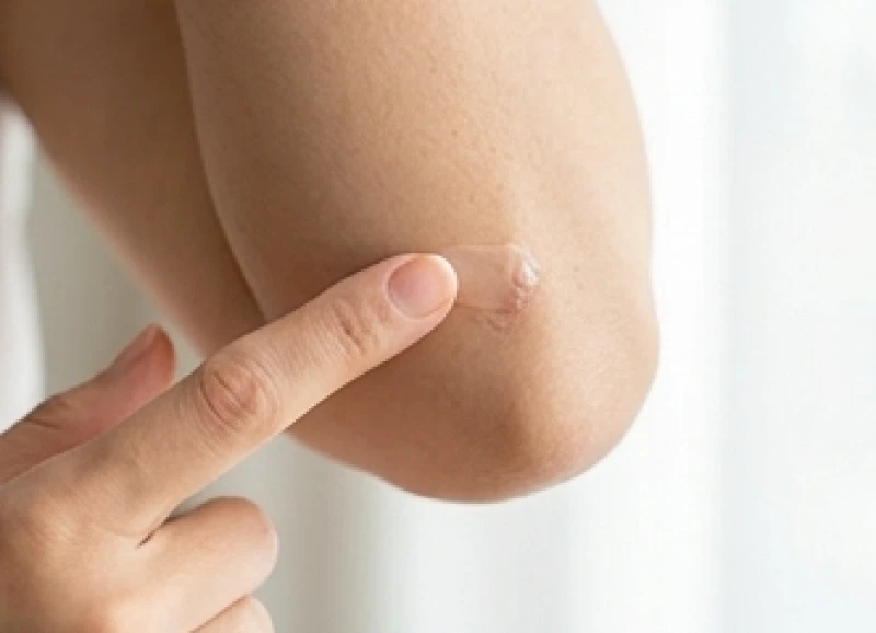 Lớp gel trị sẹo mỏng đang được thoa nhẹ nhàng lên vùng da mới bong vảy ở cùi chỏ