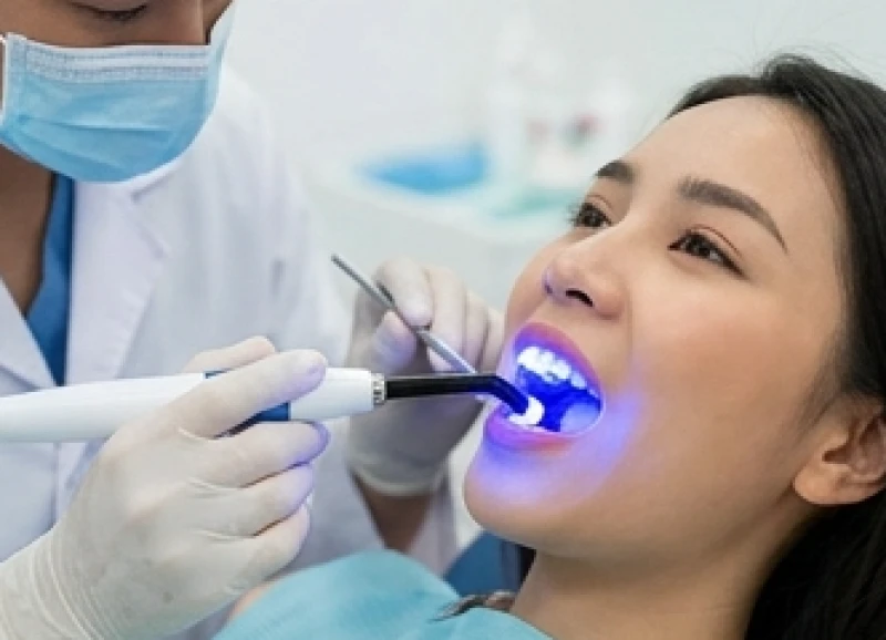 Bị mẻ răng là điềm gì: Ý nghĩa tâm linh, sơ cứu & bảng giá 10 Bác sĩ nha khoa đang chiếu đèn quang trùng hợp lên lớp vật liệu composite vừa đắp trên răng