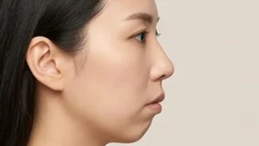 Góc nghiêng khuôn mặt người có tướng cằm lẹm với phần đỉnh cằm thụt sâu về phía cổ