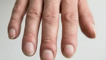 Đặc điểm tướng ngón tay dùi trống với phần đầu ngón phình to bất thường