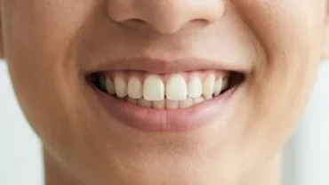 Cận cảnh nụ cười rạng rỡ của một người mang tướng răng cửa to với tỷ lệ cân đối trên khuôn mặt