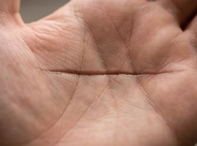 Đường sinh mệnh có dấu cắt ngang: Ý nghĩa lưu niên và cách hóa giải 4 Hình thái rãnh đứt gãy sâu cắt ngang qua đường sinh đạo trên bàn tay