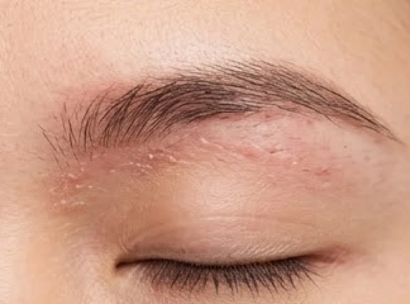 Dấu hiệu mẩn đỏ và bong vảy trắng ở chân mày cảnh báo bệnh lý da liễu
