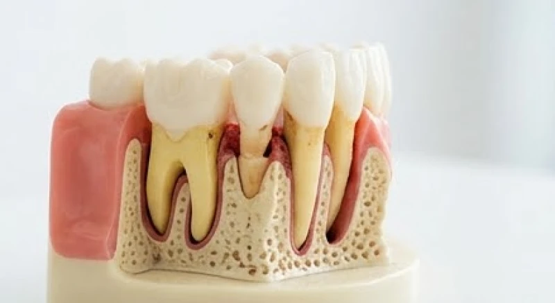 Cấu trúc mô phỏng răng bị tiêu xương và tụt nướu do bệnh viêm nha chu