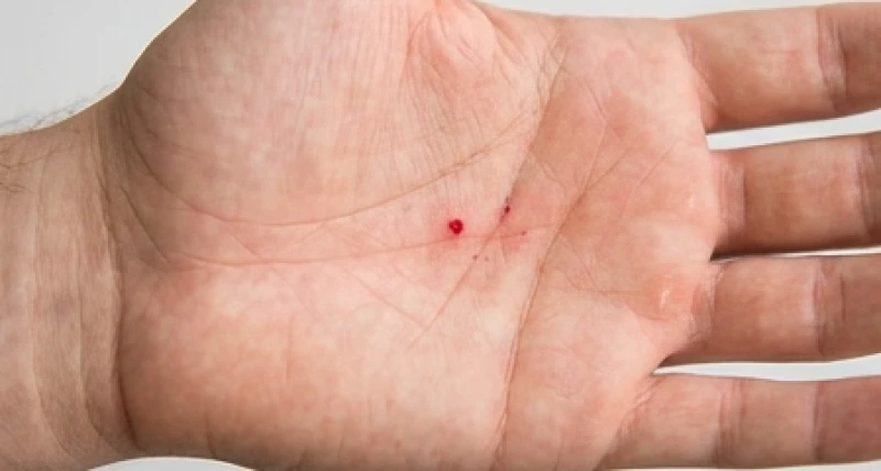 Vết xăm nốt ruồi son màu đỏ trong lòng bàn tay đang có dấu hiệu mẩn đỏ kích ứng