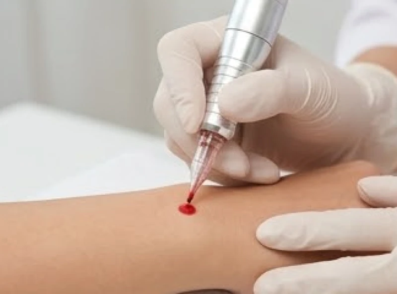 Quá trình dùng kim chuyên dụng để phun xăm tạo màu sắc đỏ nhân tạo lên vùng da cổ tay một cách cẩn thận